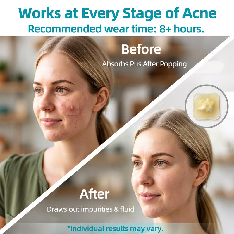 Hydrocolloid Acne Patch Roll