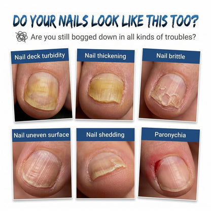 Toenail Fungus Defense Treatment