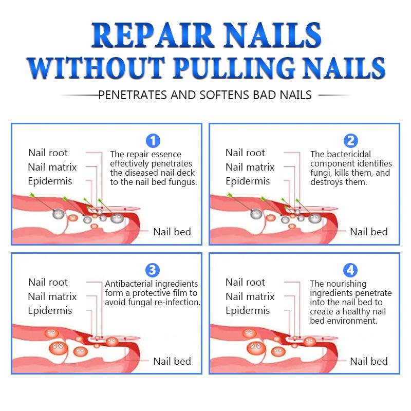 Toenail Fungus Defense Treatment